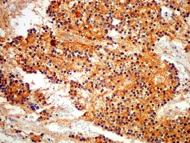 Adrenal_Neuroblastoma5_CG_UNICAMP_resized.jpg