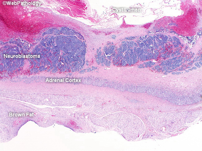 Adrenal_Neuroblastoma7_Cystic.jpg
