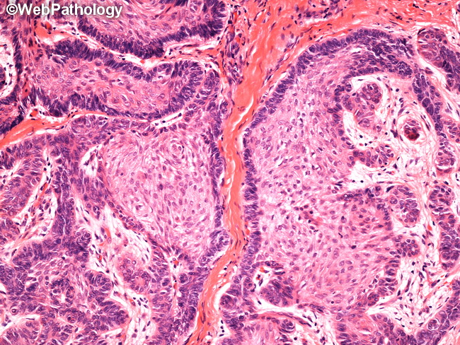 Ameloblastoma12A.jpg