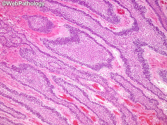 Ameloblastoma17A.jpg