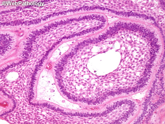 Ameloblastoma22A.jpg