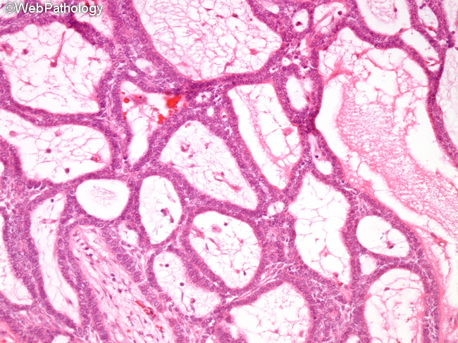 Ameloblastoma6_Plexiform.jpg