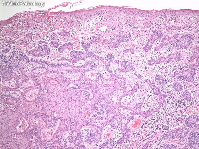 Ameloblastoma_Extraosseous3_OralCavity.jpg