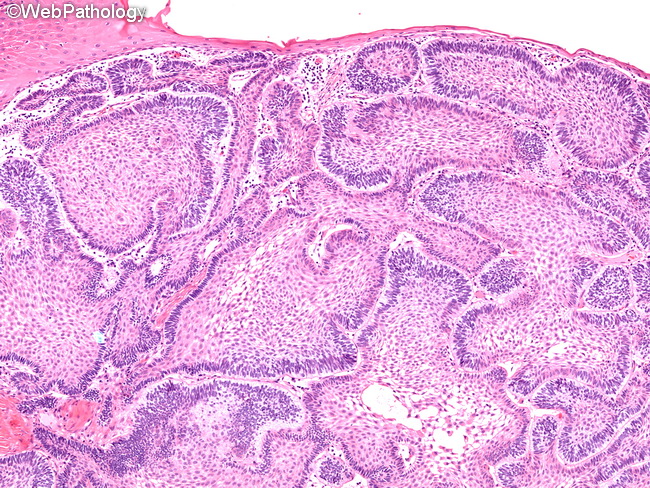 Ameloblastoma_Extraosseous4_OralCavity.jpg
