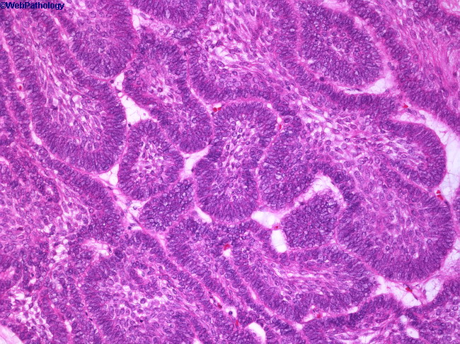 Ameloblastoma_Maxilla3.jpg