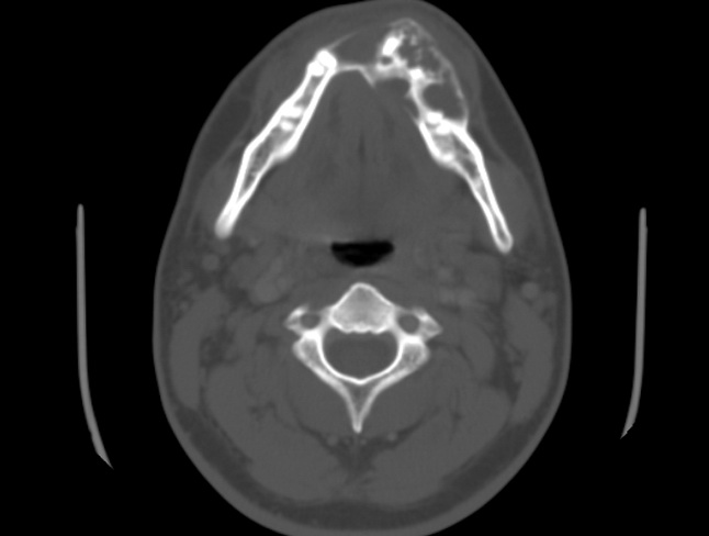 Ameloblastoma_Radiology3_cropped.jpg