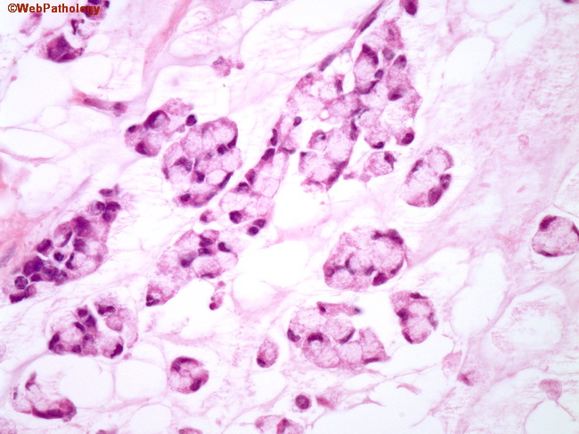 Signet-ring cell carcinoma of the ampulla of Vater: a case diagnosed via  repeated biopsies | Clinical Journal of Gastroenterology