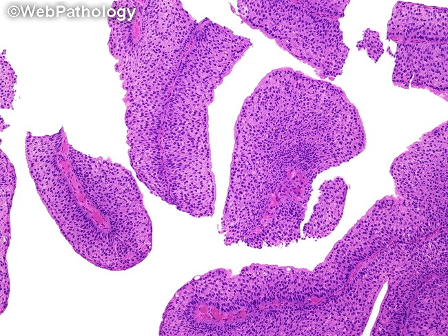 Bladder_UrothelialCarcinoma_PUNLMP4A.jpg