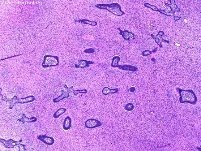 ameloblastic fibroma