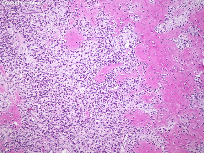 Bone_Chondroblastoma2.jpg