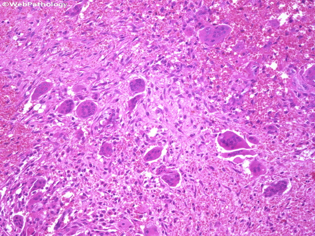 Peripheral Giant Cell Granuloma Histology