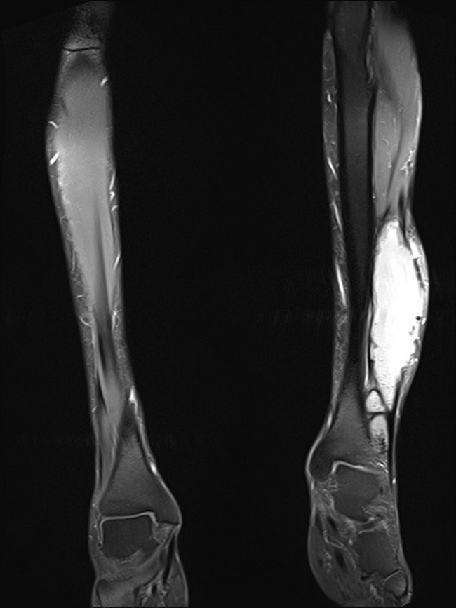 Bone_MyositisOssificans_Radiology3B.jpg