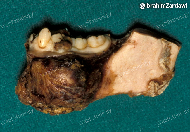 Bone_Osteosarcoma_Gnathic1_resized.jpg