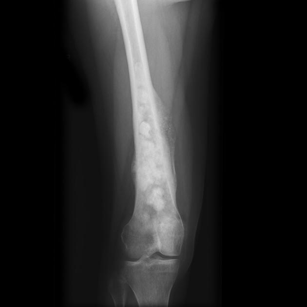 Bone_Osteosarcoma_Radiology_1A.jpg