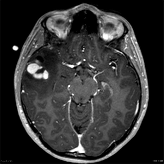 Brain_Astrocytoma_PXA_MRI(1).jpg