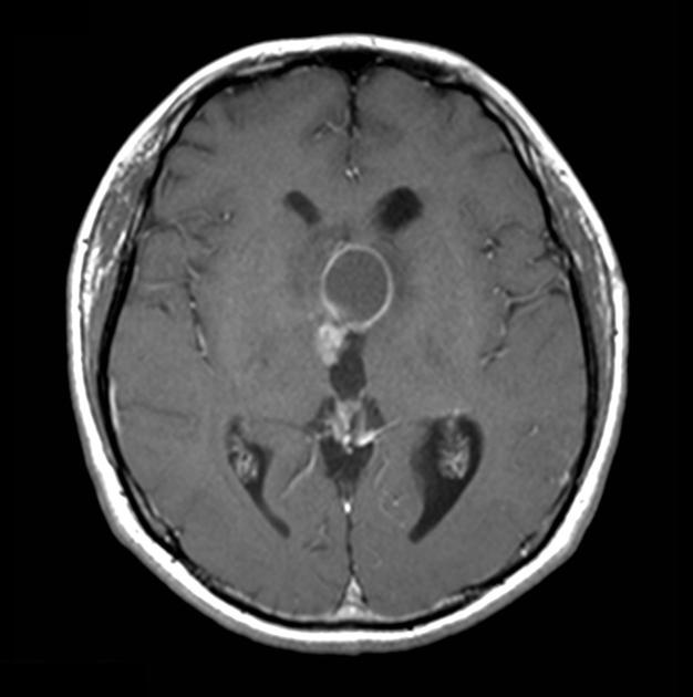 Brain_Craniopharyngioma_Radiology1.jpg