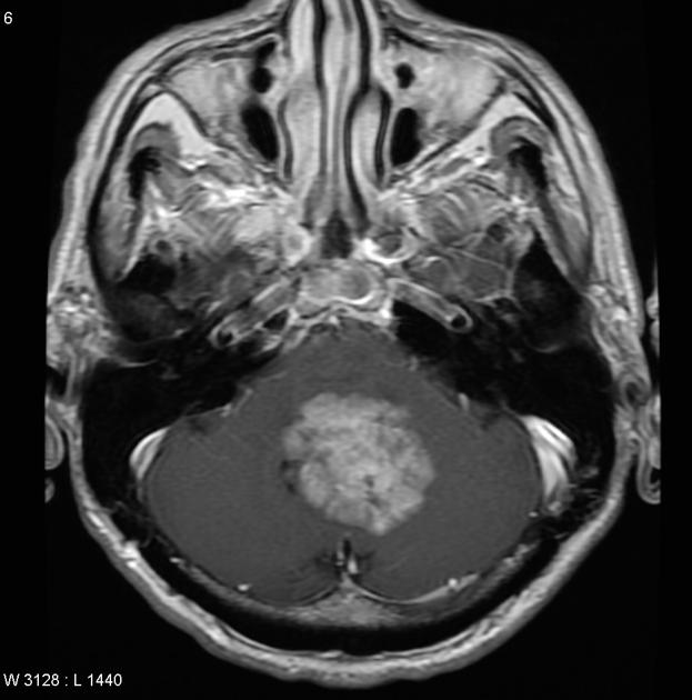 Brain_Ependymoma_MRI1.jpg