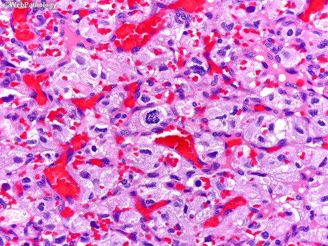 Brain_Hemangioblastoma16.jpg