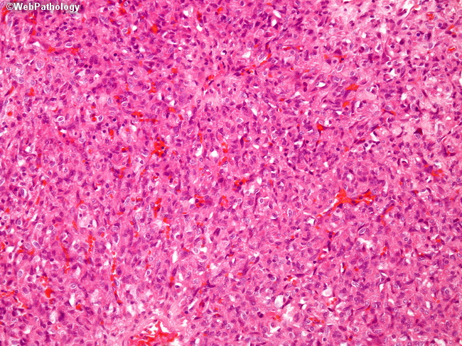 Brain_Hemangioblastoma28.jpg