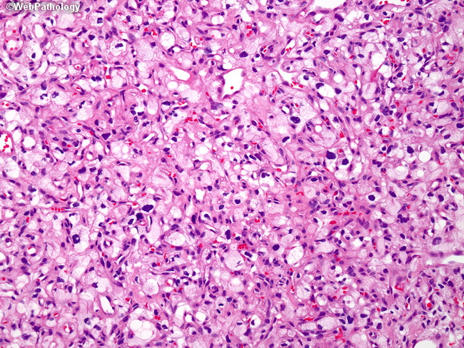 Brain_Hemangioblastoma3.jpg