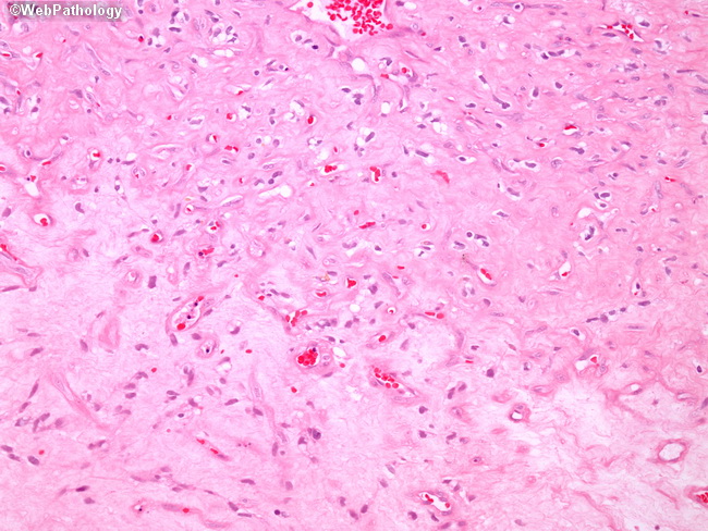 Brain_Hemangioblastoma8.jpg