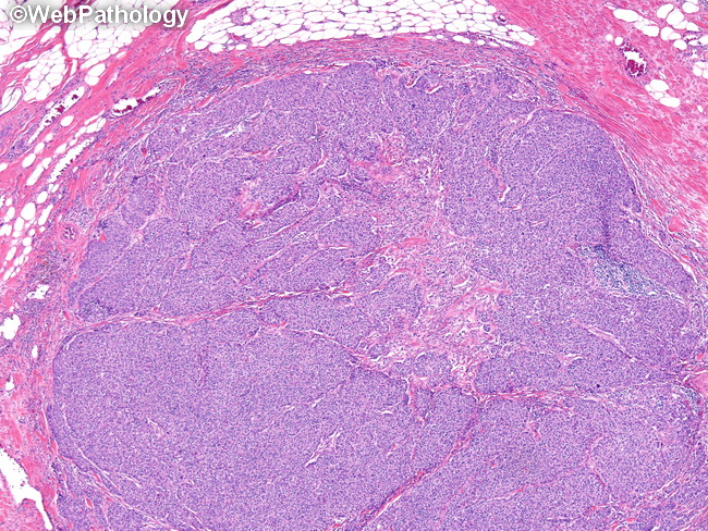 invasive ductal carcinoma histology