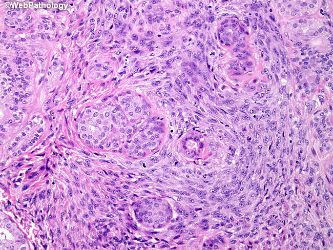spindle cell neoplasm