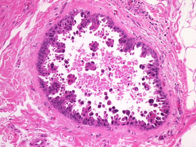 Breast_Carcinoma_DCIS3_Micropapillary.jpg