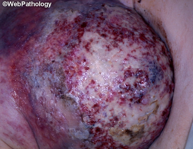 Breast_Carcinoma_Pagets1_Gross.jpg