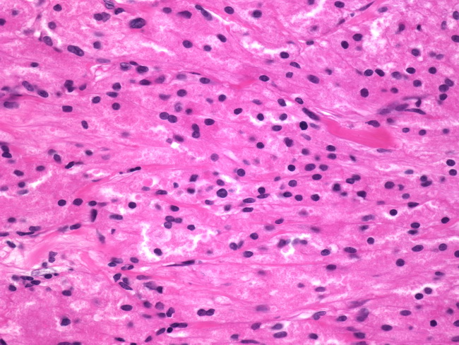 granular cell tumor larynx