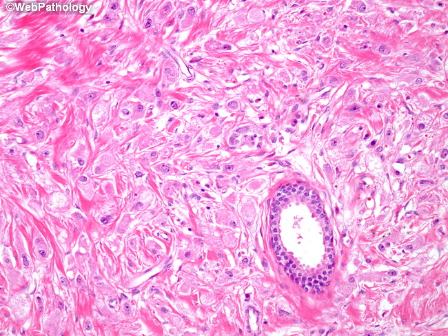Breast_LobularCA54_Histiocytoid.jpg
