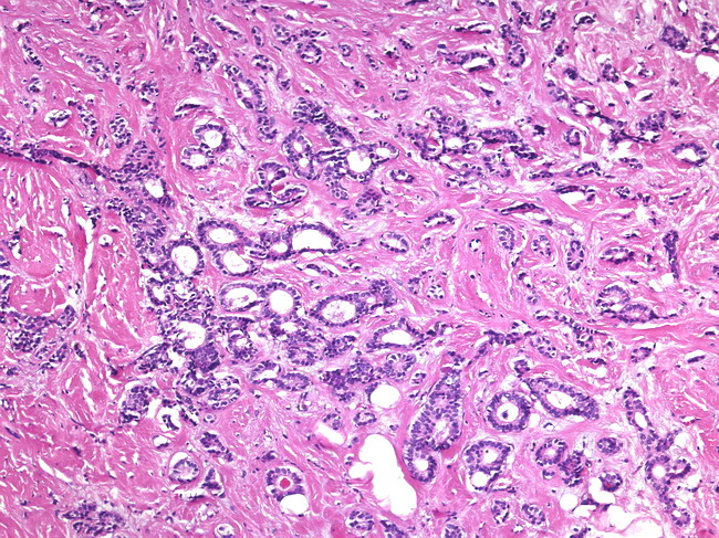 tubular carcinoma breast