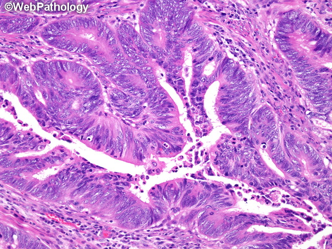 adenocarcinoma colon histology