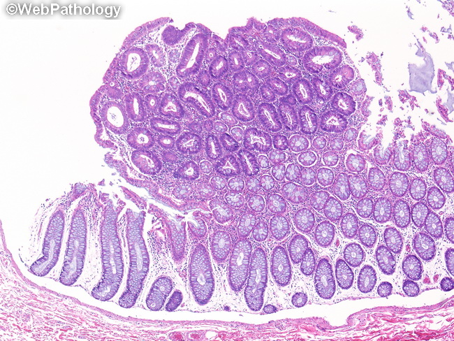villous adenoma histology