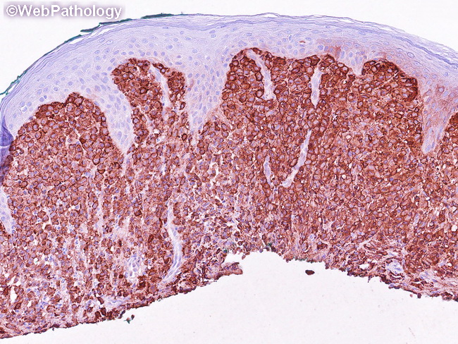 CutaneousMastocytosis16_tryptase.jpg