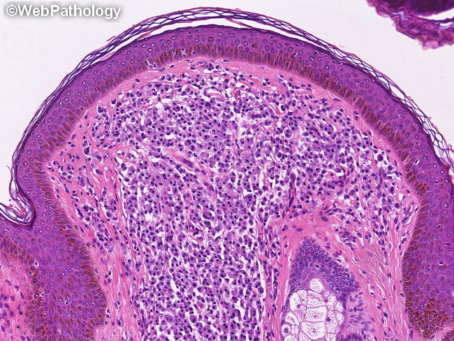 CutaneousMastocytosis4.jpg