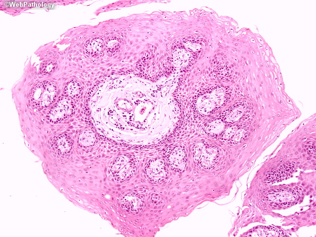 squamous papilloma histology