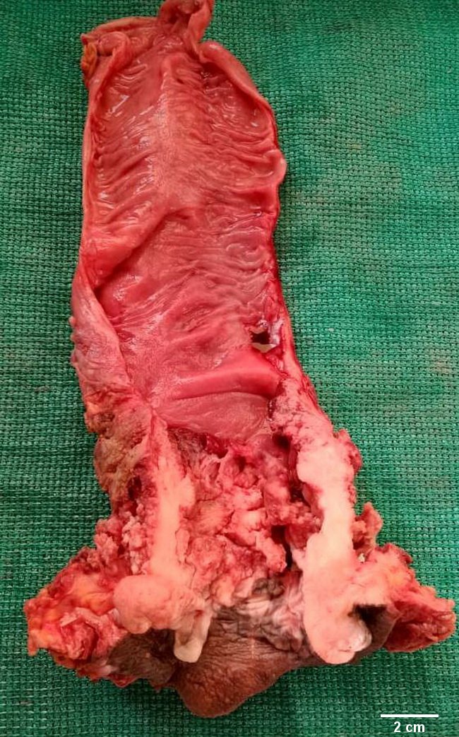 squamous cell carcinoma bladder gross