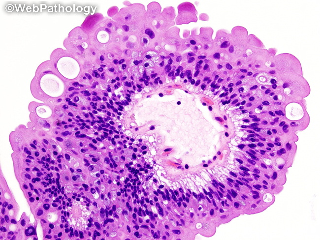 GU_Bladder_Benign_UrothelialPapilloma41_resized.jpg