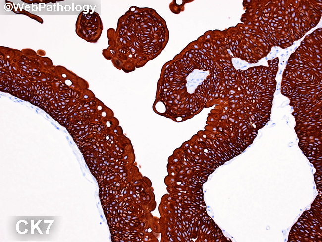 GU_Bladder_Benign_UrothelialPapilloma45_CK7_resized.jpg