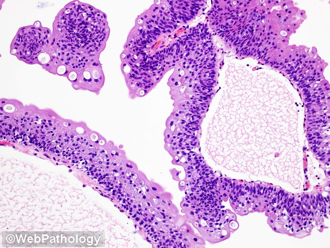 GU_Bladder_Benign_UrothelialPapilloma46_resized.jpg