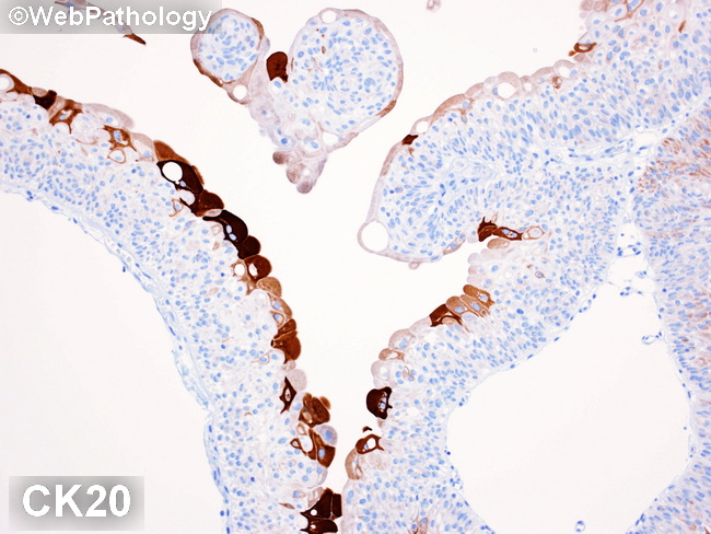 GU_Bladder_Benign_UrothelialPapilloma47_CK20_resized.jpg