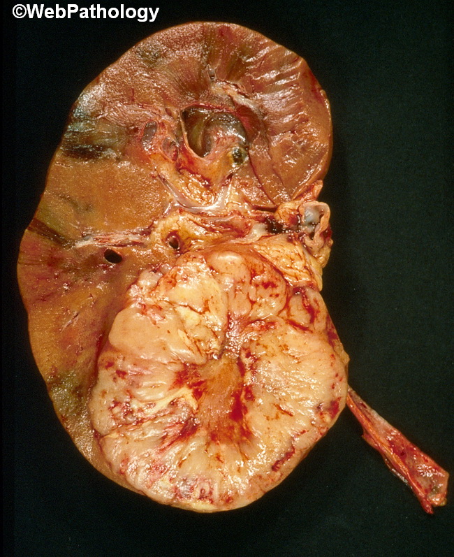 HemePath_DLBCL_Kidney1.jpg