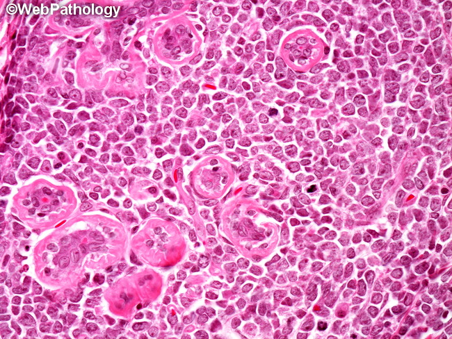 HemePath_GranulocyticSarcoma13_Breast.jpg