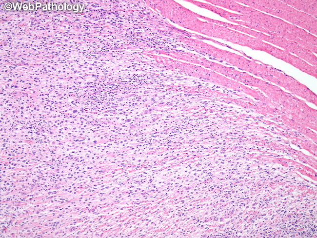HemePath_HistiocyticSarcoma23.jpg
