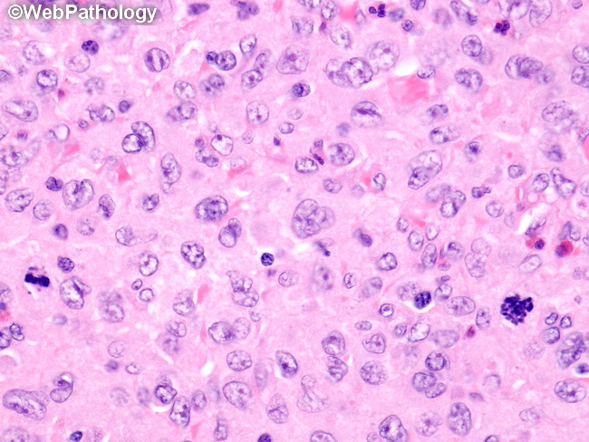 HemePath_HistiocyticSarcoma8.jpg