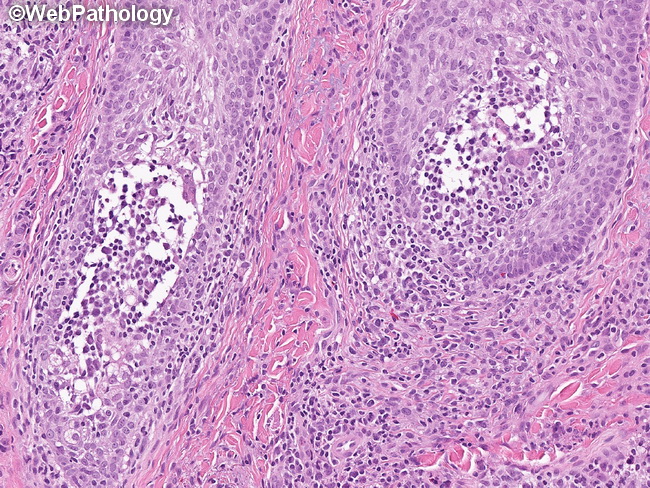 mycosis fungoides histology