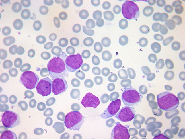 HemePath_MantleCellLymphoma_Leukemia1_resized.jpg