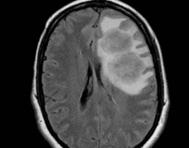 HemePath_MyeloidSarcoma_Radiology1_resized.jpg