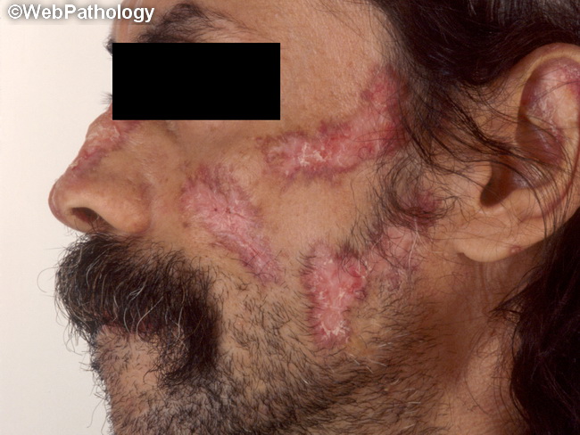 discoid lupus scars